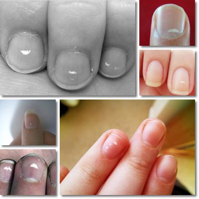 White spots on nails