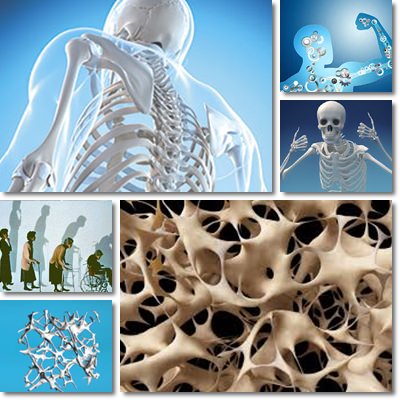 Osteoporosis treatment