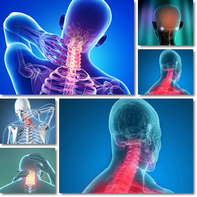 neck osteoarthritis