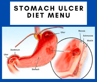 Stomach Ulcer Diet Menu