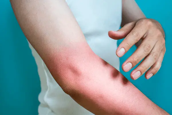  uses of olive oil for Sunburn Relief