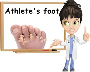 Athlete's foot causes