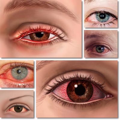 Conjunctivitis