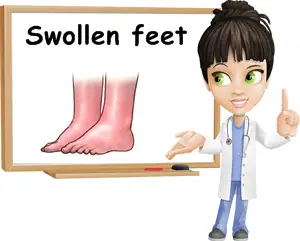 Swollen feet causes