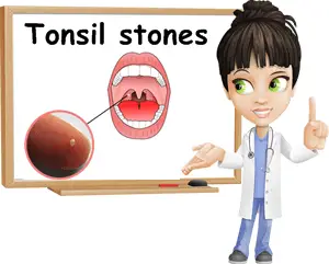 Tonsil stones causes