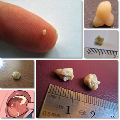 Tonsil stones