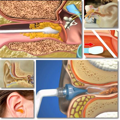 Ear Wax Color Chart