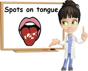 Spots on tongue causes