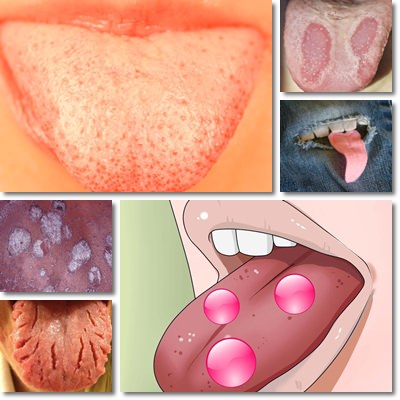 Spots on tongue