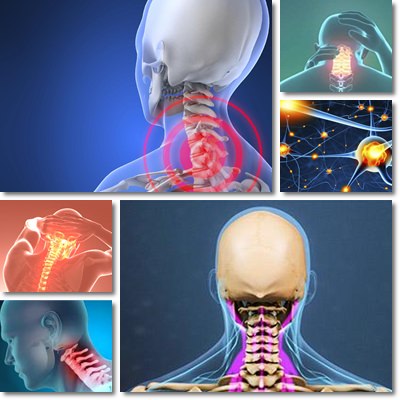 cervical osteoarthritis symptoms