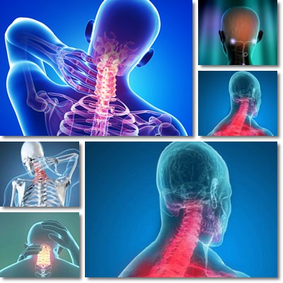 cervicobrachial syndrome treatment